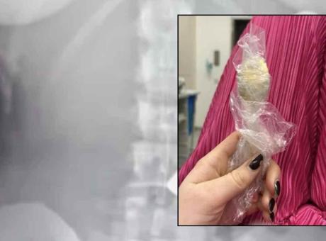 Belçika'daki Garip Olay: Yoğurt Yerken Boğulma Tehlikesi Geçiren Kadın, 17 Santimetrelik Kaşığı İki Gün Sonra Vücudundan Attırdı