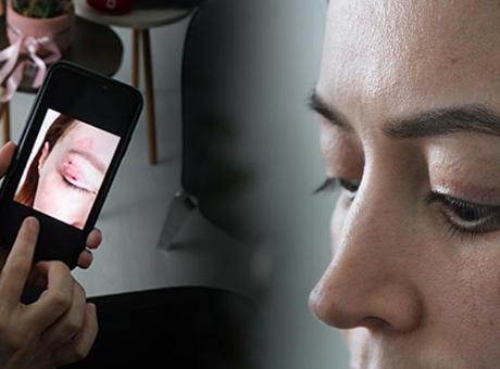 Güzellik Salonu İşlemi Sonrası Kalıcı Hasar: Elif T. Davacı Oldu