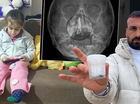 5 Yaşındaki Polen'in Burnundan Çıkarılan Gizemli Cisim, Şok Etkisi Yarattı!